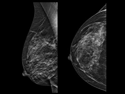 Pristina Recon DL - Deep learning in 3D breast image reconstruction