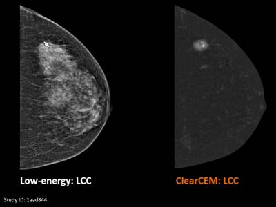 Clarity for diagnostic confidence: ClearCEM on MAMMOMAT B.brilliant